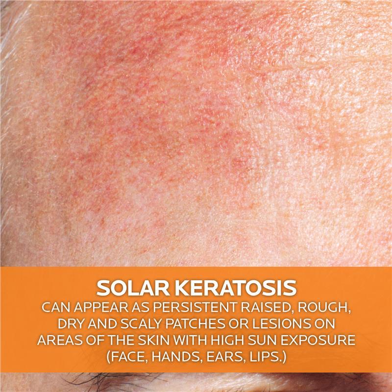La Roche Posay Anthelios KA+ SPF50+ 50ml